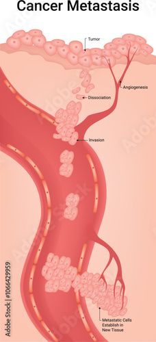 Cancer Metastasis Science Design Illustration Diagram
