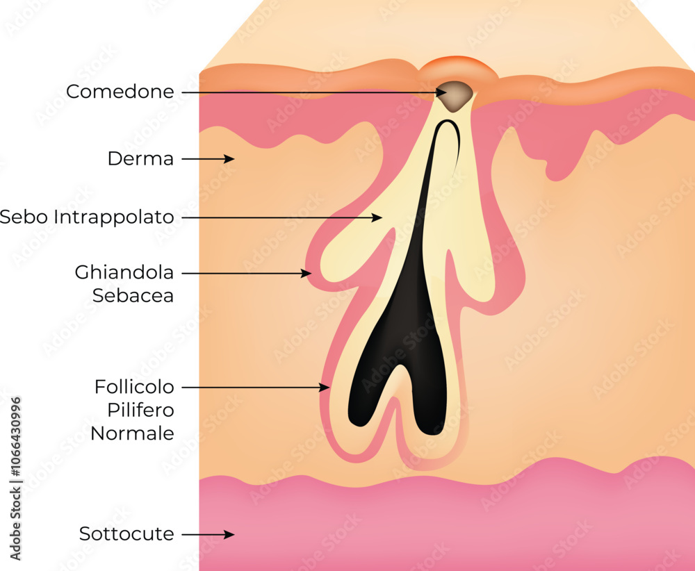 Comedone Derma Sottocute Science Design Vector Illustration Diagram Comedone Derma Sottocute Science Design Vector Illustration Diagram