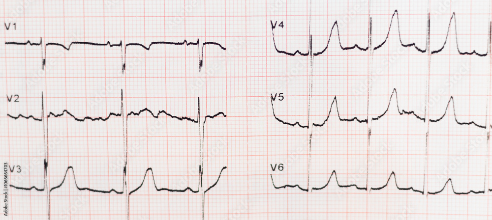 Electrocardiogram. ECG show heart wave, cardiogram report. Learning Cardiovascular disease (CVD). Electrocardiogram. ECG show heart wave, cardiogram report. Learning Cardiovascular disease (CVD).