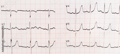 Electrocardiogram. ECG show heart wave, cardiogram report. Learning Cardiovascular disease (CVD).