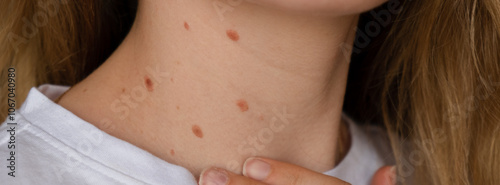 Unrecognizable woman showing her Birthmarks on neck skin Close up detail of the bare skin Sun Exposure effect on skin, Banner Health Effects of UV Radiation Woman with birthmarks Pigmentation and lot