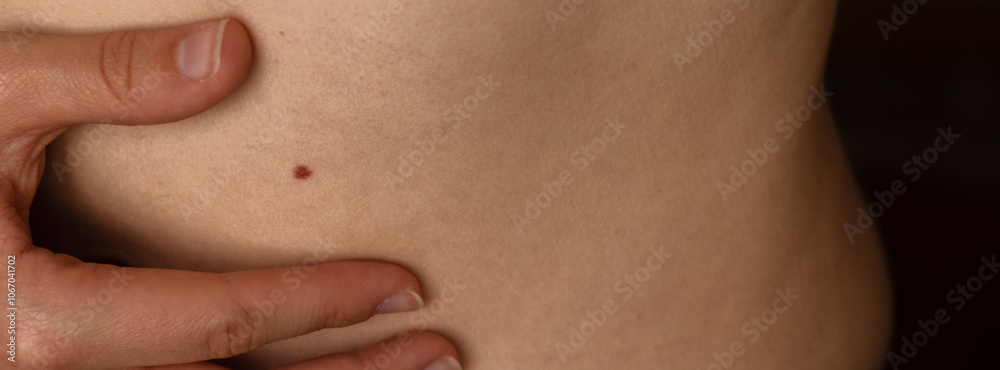Unrecognizable woman showing her Birthmarks on skin Close up detail of the bare skin Sun Exposure effect on skin, Banner Health Effects of UV Radiation Woman with birthmarks Pigmentation and lot of Unrecognizable woman showing her Birthmarks on skin Close up detail of the bare skin Sun Exposure effect on skin, Banner Health Effects of UV Radiation Woman with birthmarks Pigmentation and lot of