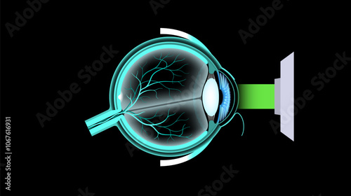 LASIK eye surgery