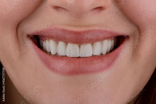 Female smile makeover by dental ceramic veneer, porcelain laminate veneers. photo