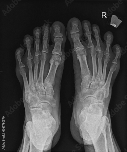 Foot X-Ray: Detailed Imaging of Bones and Joints for Podiatric Health Assessment photo