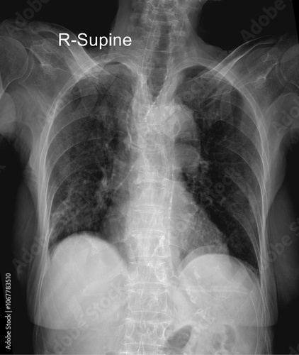 Chest X-Ray Supine for Diagnostic Use