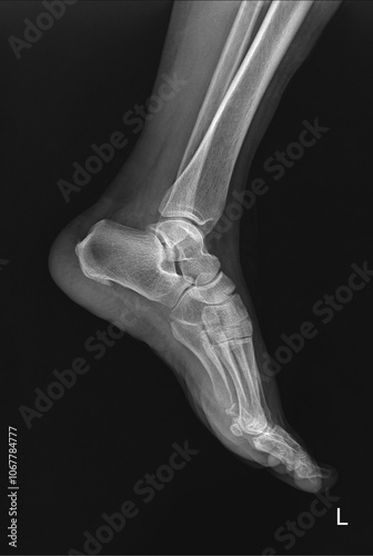 Ankle Joint X-Ray in Lateral View