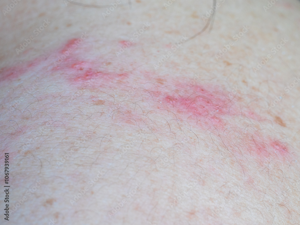 Fototapeta premium Shingles (Herpes Zoster, Shingles) is a type of skin disease. This is caused by the Varicella Zoster Virus,. Causes inflammation of the nerves burning pain and a rash along the nerves.