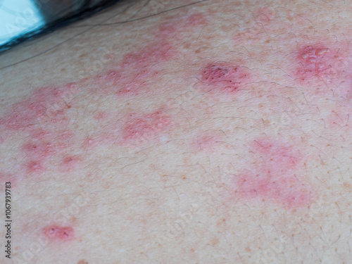 Shingles (Herpes Zoster, Shingles) is a type of skin disease. This is caused by the Varicella Zoster Virus,. Causes inflammation of the nerves burning pain and a rash along the nerves. photo