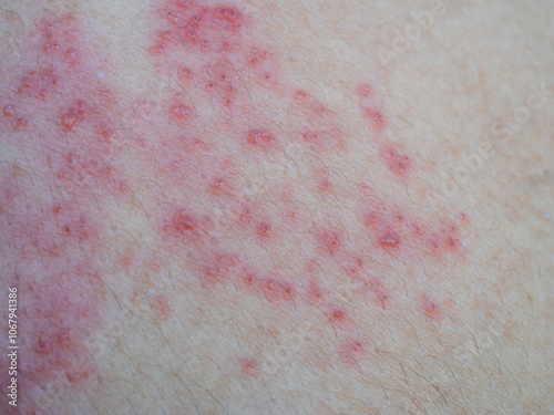 Shingles (Herpes Zoster, Shingles) is a type of skin disease. This is caused by the Varicella Zoster Virus,. Causes inflammation of the nerves burning pain and a rash along the nerves. photo