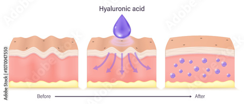 Hyaluronic acid vector. Comparison of skin before and after hyaluronic acid use. Vector for advertising about beauty and medical treatment.