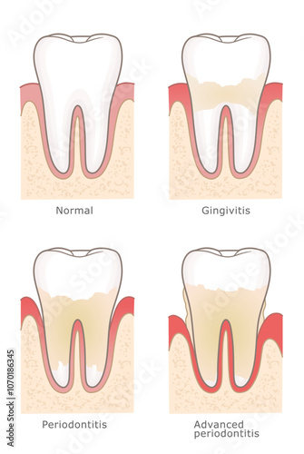 Gum inflammation stages gingivitis and periodontitis. Four stages of human gum inflammation development, vector illustration.
