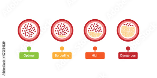 Atherosclerosis Levels Science Design. Vector Illustration.