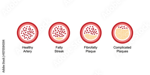 Atherosclerosis Levels Science Design. Vector Illustration.