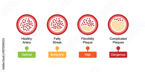Atherosclerosis Levels Science Design. Vector Illustration.