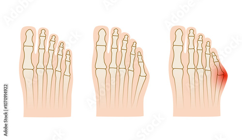 Taylor deformation. Valgus deformity of the little toe joint. Vector illustration.