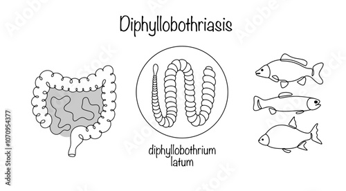Diphyllobothriasis