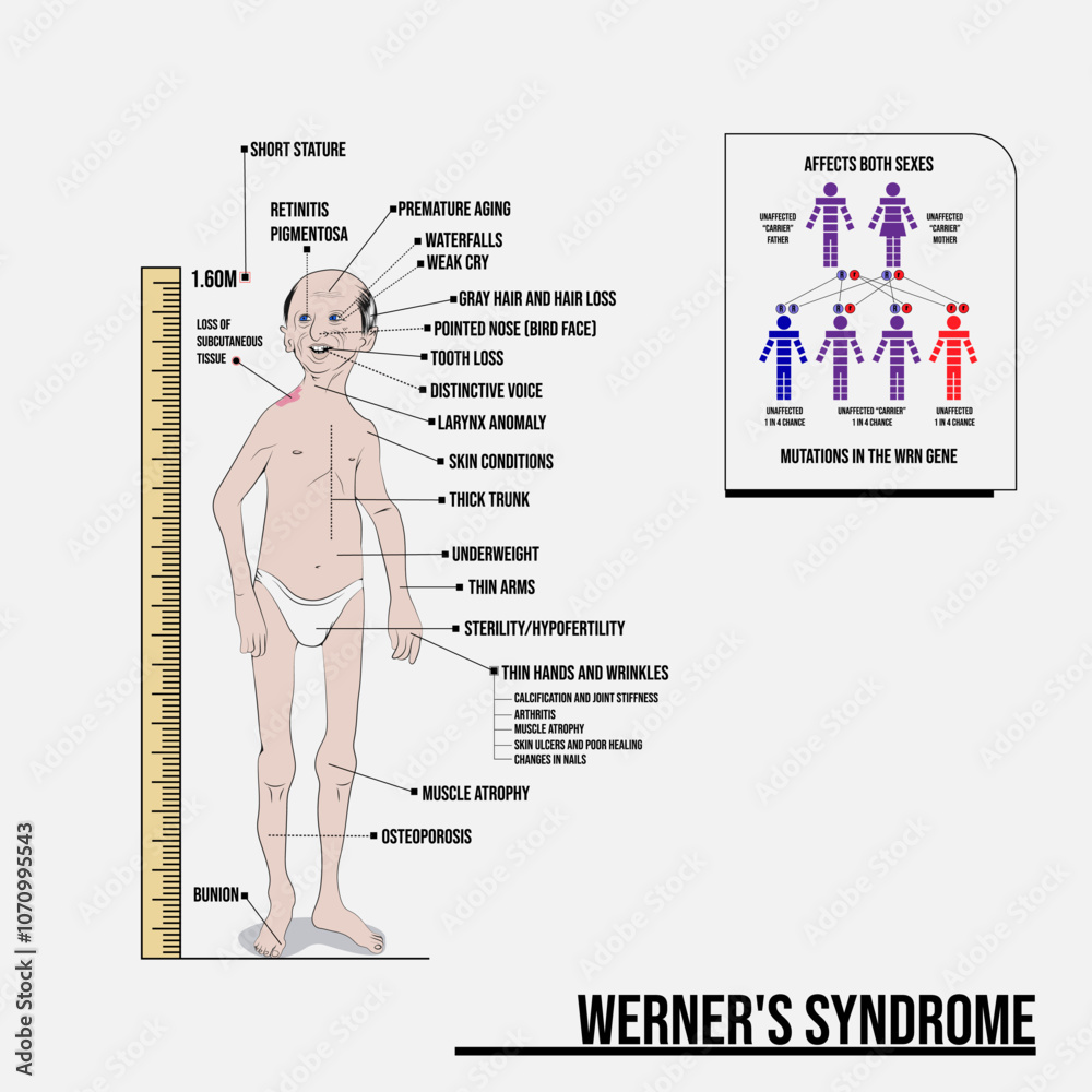 Werner syndrome, premature aging with onset in the third decade.