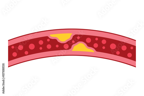 High blood cholesterol colorful icon with a arteriosclerosis risk. Clogged artery. Concept of high cholesterol and unhealthy lifestyle, fast food. thrombosis microvascular disease. Vector illustration