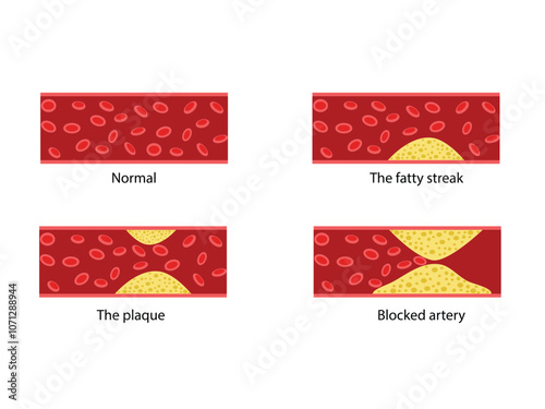 Cholesterol in human blood vessels. Normal artery, fatty streak, plaque, blocked vascular