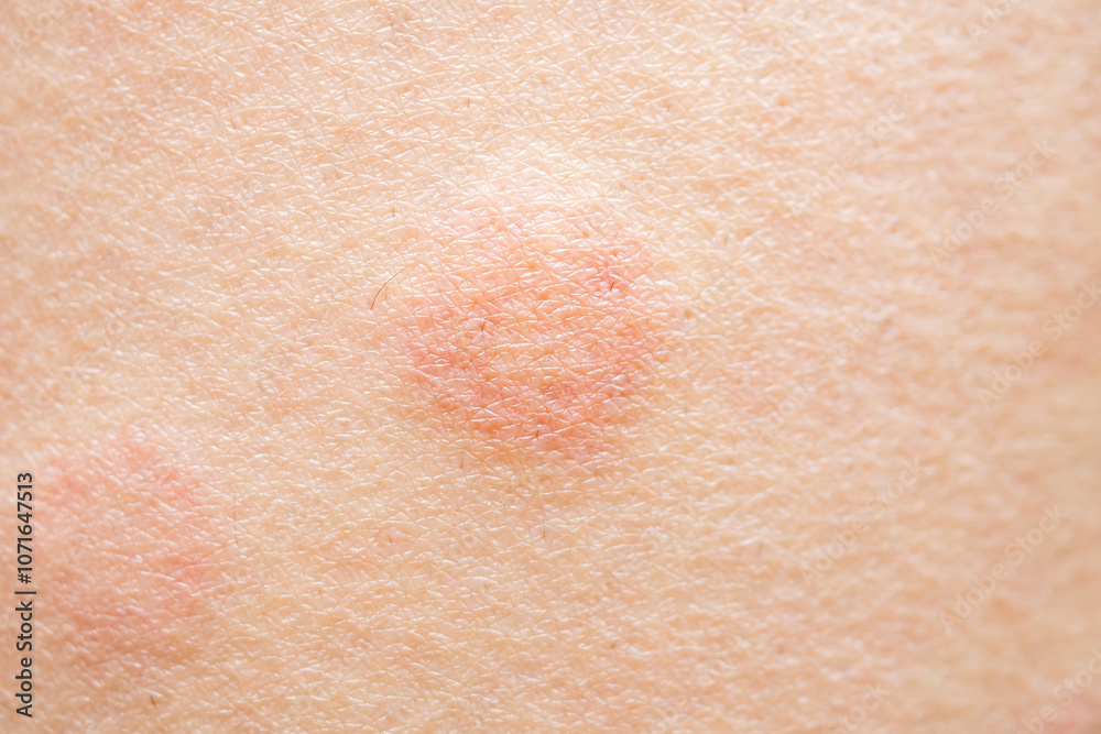 Fototapeta premium Skin allergy rash dermatitis texture close up background