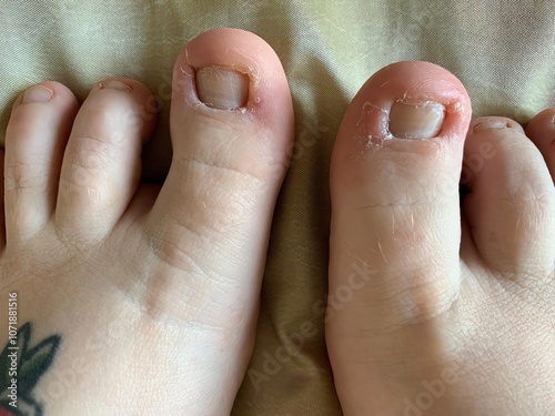 Female foot with big toe with ingrowing toenail damage