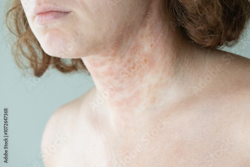 View of a young woman's neck. Atopic dermatitis. Eczema. Skin condition.