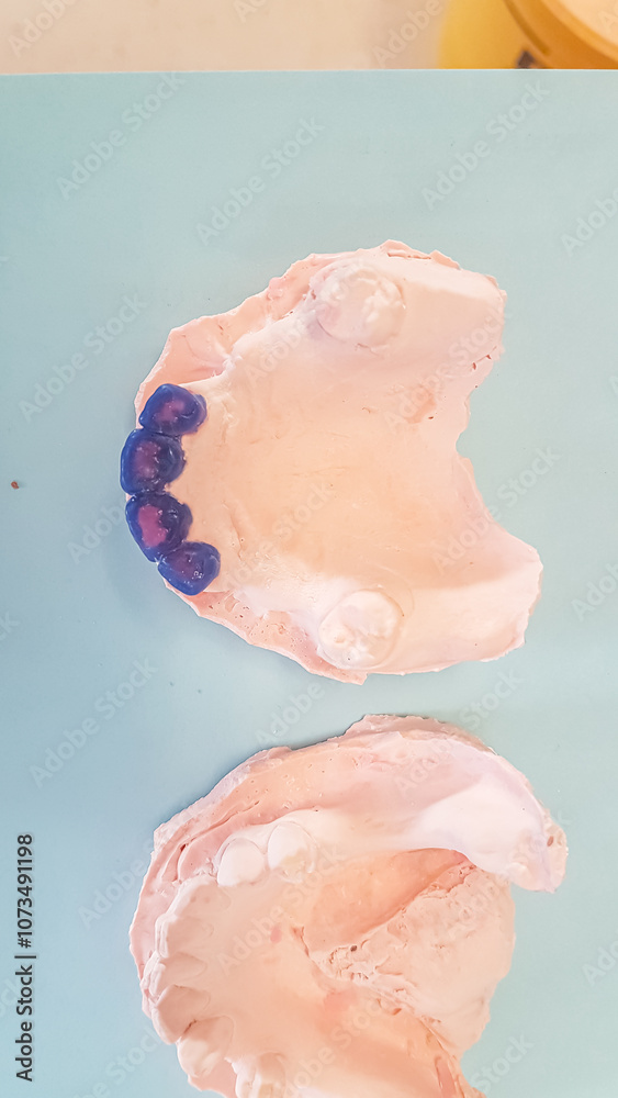 Dental prosthesis case patient's maxillary and mandibular cast models in dental plaster, showing edentulous molars and premolars with a blue wax-up on frontal incisors. Overhead, directly above view. Dental prosthesis case patient's maxillary and mandibular cast models in dental plaster, showing edentulous molars and premolars with a blue wax-up on frontal incisors. Overhead, directly above view.