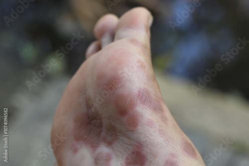inflamed, peeling and damaged foot skin due to R-CHOPP chemotherapy treatment