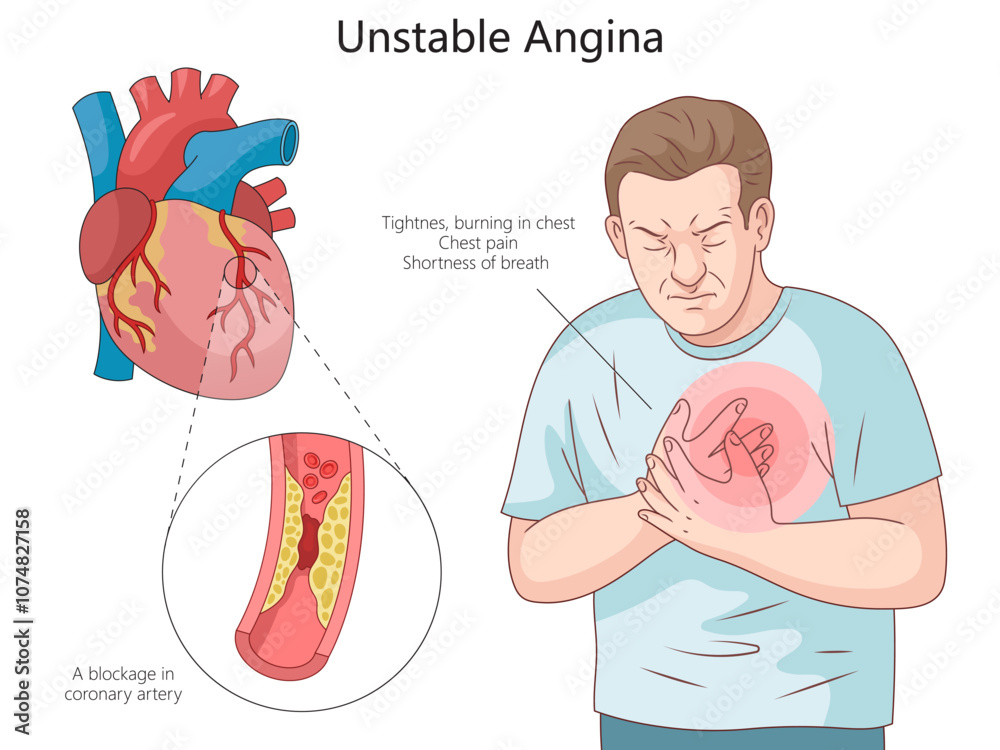Poster symptoms of unstable angina and blockage in coronary arteries ...