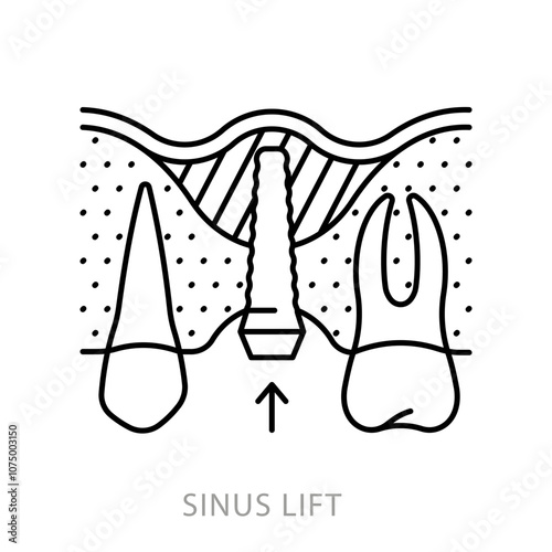 Sinus lift, icon. Sinus lift with dental implant. Linear illustration of procedure to provide sufficient bone and replacement tooth. Dentistry and teeth restoration topic. Editable stroke icon