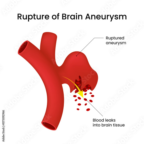 Rupture of the Brain Aneurysm