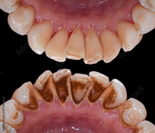 teeth tartar and calculus cleaning 