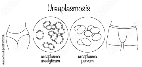 Ureaplasmosis photo