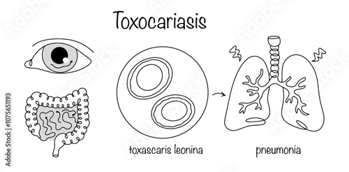 Toxocariasis