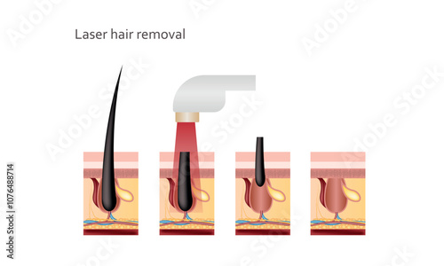 Laser hair removal, effects of laser on hair. Realistic vector