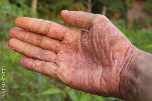 inflamed, peeling and damaged hand skin due to R-CHOPP chemotherapy treatment