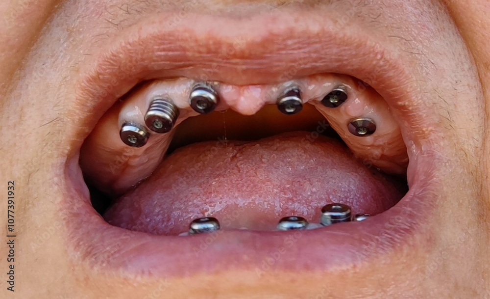 Obraz premium Dental implants, all in six, dental ceramic restoration, 37.