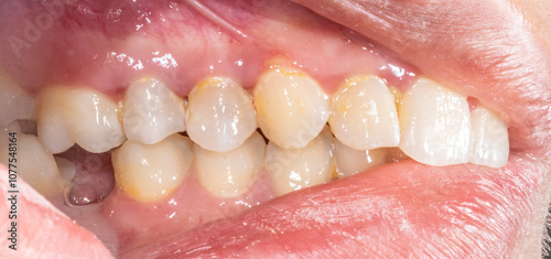 Lateral view of dental arches in biting occlusion with a lost lower molar tooth missing crown. Yellow colored spots teeth closeup macrophotography indirect mirror view open mouth retracted lips.