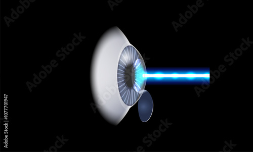 LASIK eye surgery