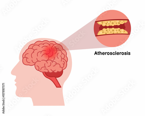 Atherosclerosis brain Stroke disease blocked blood vessel human brain stroke vector illustration