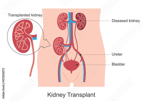 Kidney transplant or renal transplant.
