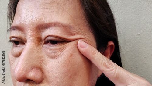 portrait the fingers holding the flabbiness and wrinkle beside the eyelid, swelling and ptosis under the eye, scar and freckles on the face of the woman, health care and beauty concept.