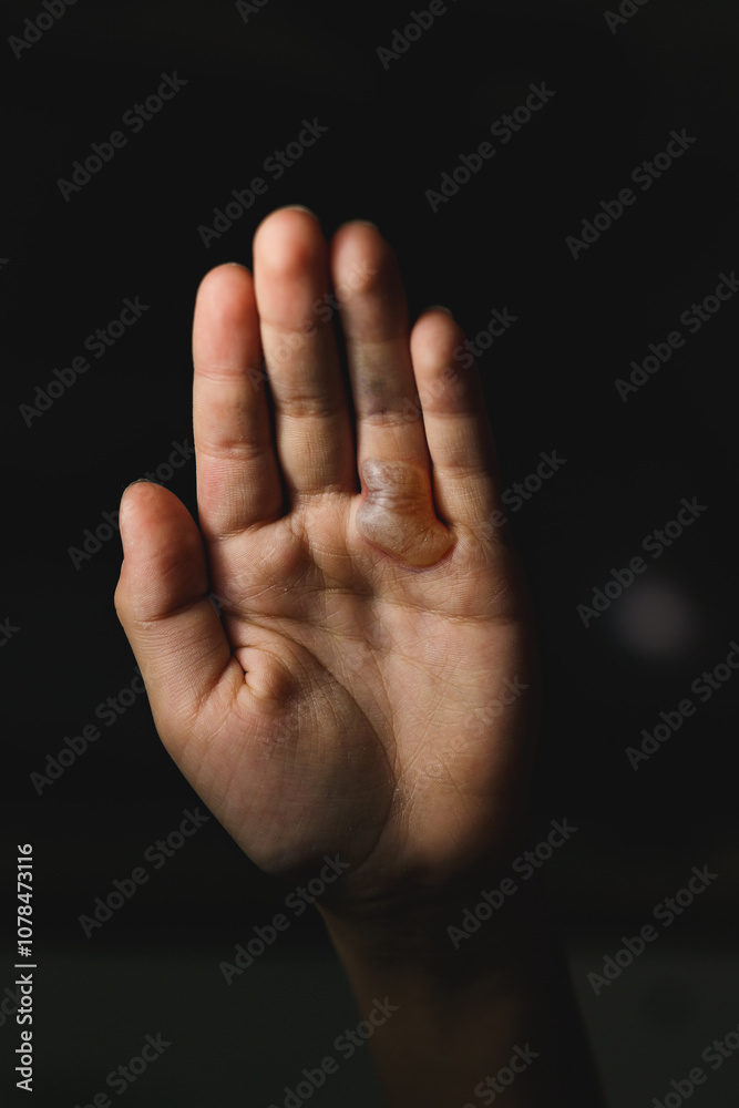 Child arm with actual second degree burn Child arm with actual second degree burn