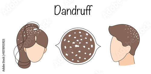 Dandruff