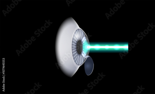 LASIK eye surgery