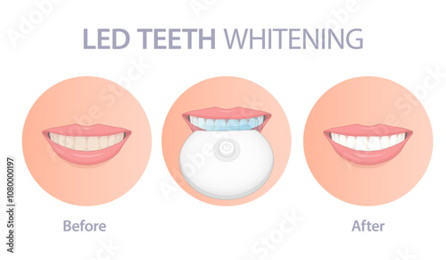 LED teeth whitening vector illustration.