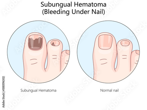 subungual hematoma bleeding under nail with a normal nail, showing discoloration and injury effects diagram hand drawn schematic vector illustration. Medical science educational illustration