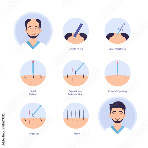 Cartoon Color Hair Transplantation Process Alopecia and Hairloss Treatment Infographic Concept Flat Design Style. Vector illustration