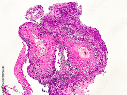 Esophageal squamous cell carcinoma G-2, light micrograph, photo under microscope photo